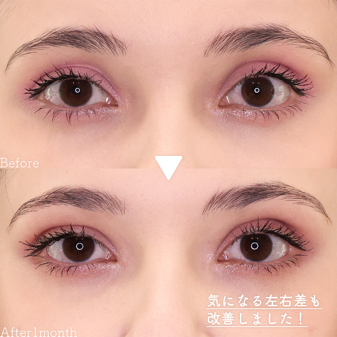 二重埋没法/TAC式 ツヤ肌コラーゲンリフト®/ジョールファット除去の症例写真 施術前後 