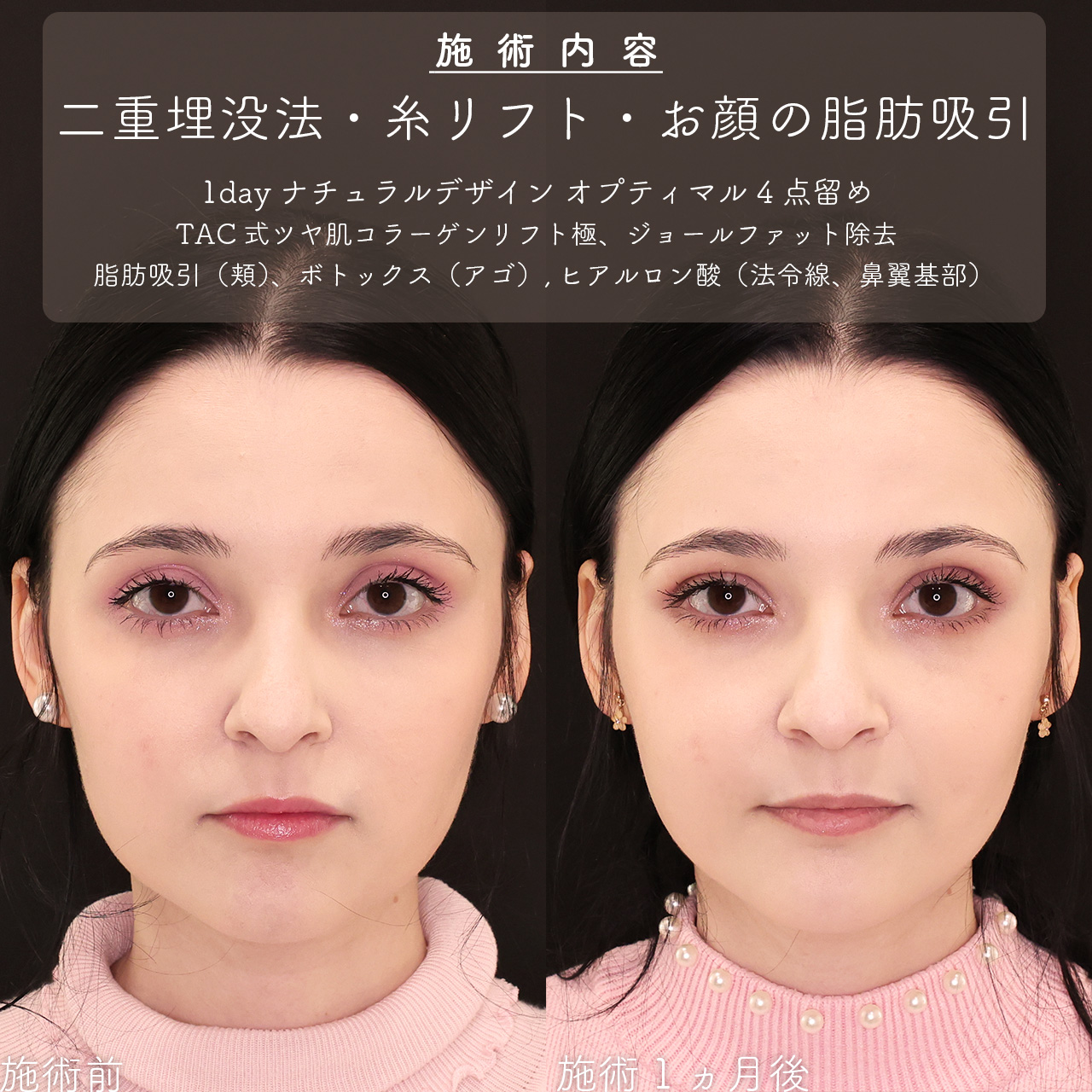 二重埋没法/TAC式 ツヤ肌コラーゲンリフト®/ジョールファット除去の症例写真 施術前後 