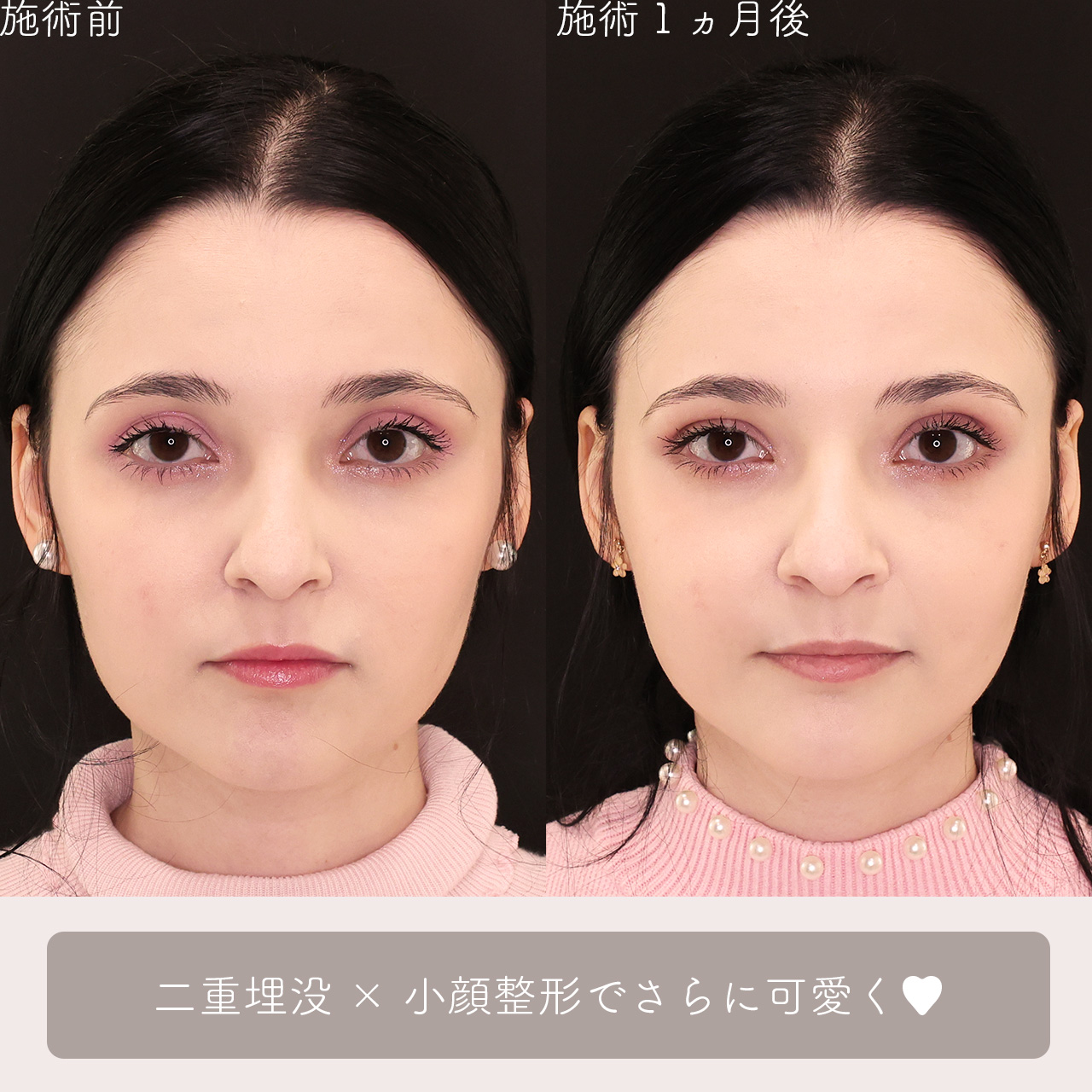 二重埋没法/TAC式 ツヤ肌コラーゲンリフト®/ジョールファット除去の症例写真 施術前後 