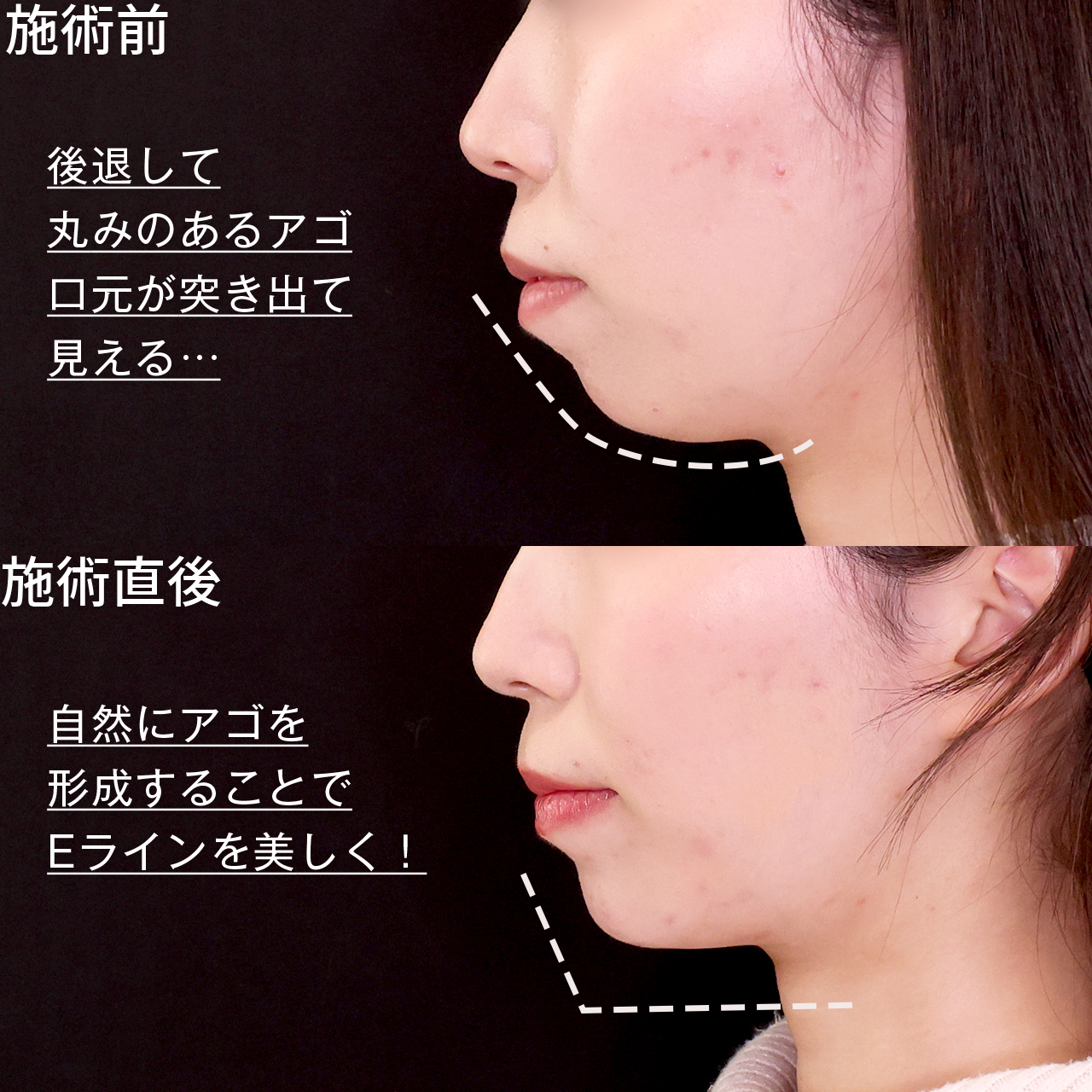 顎のヒアルロン酸注射/TAC式 ツヤ肌コラーゲンリフト®の症例写真 施術前後 