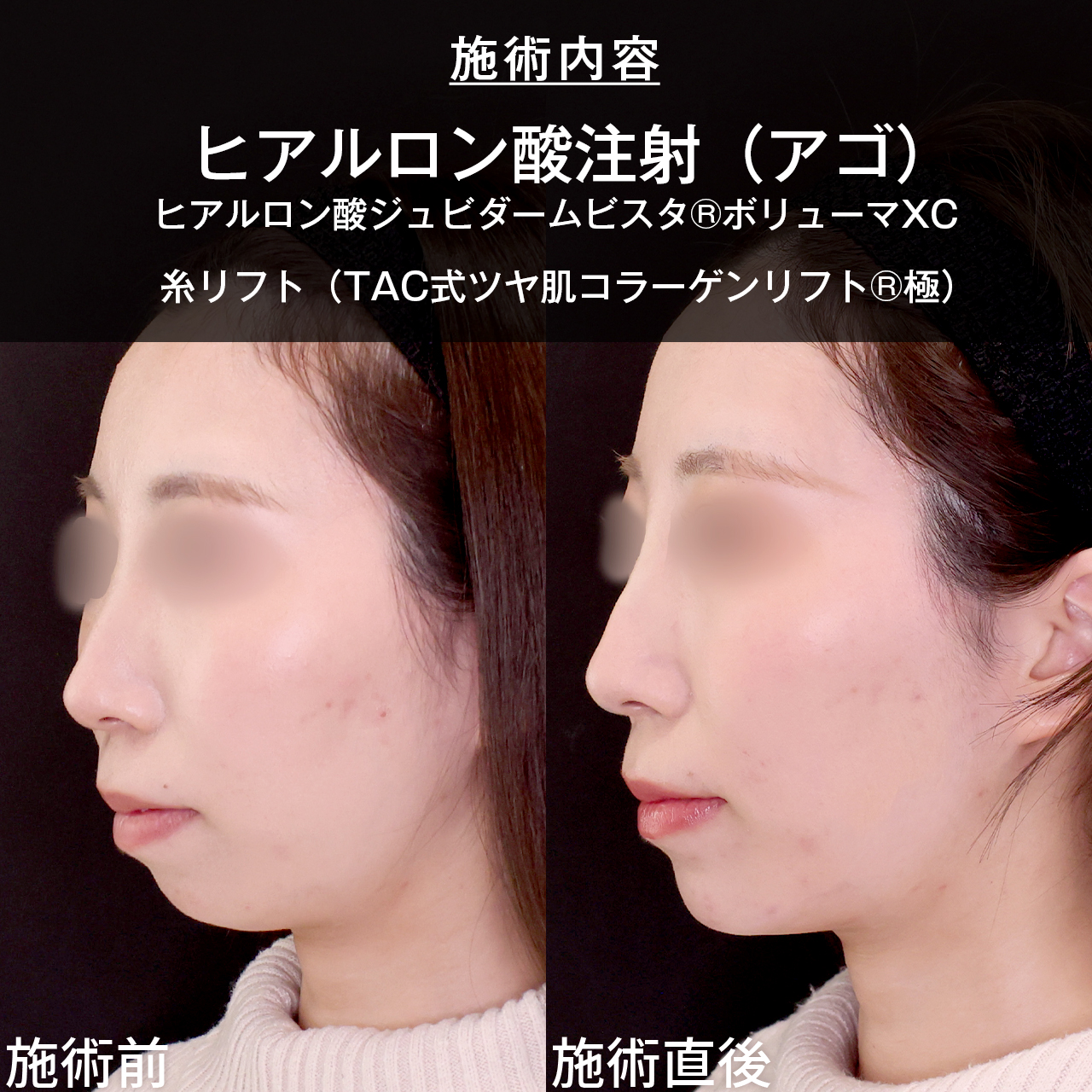 顎のヒアルロン酸注射/TAC式 ツヤ肌コラーゲンリフト®の症例写真 施術前後 