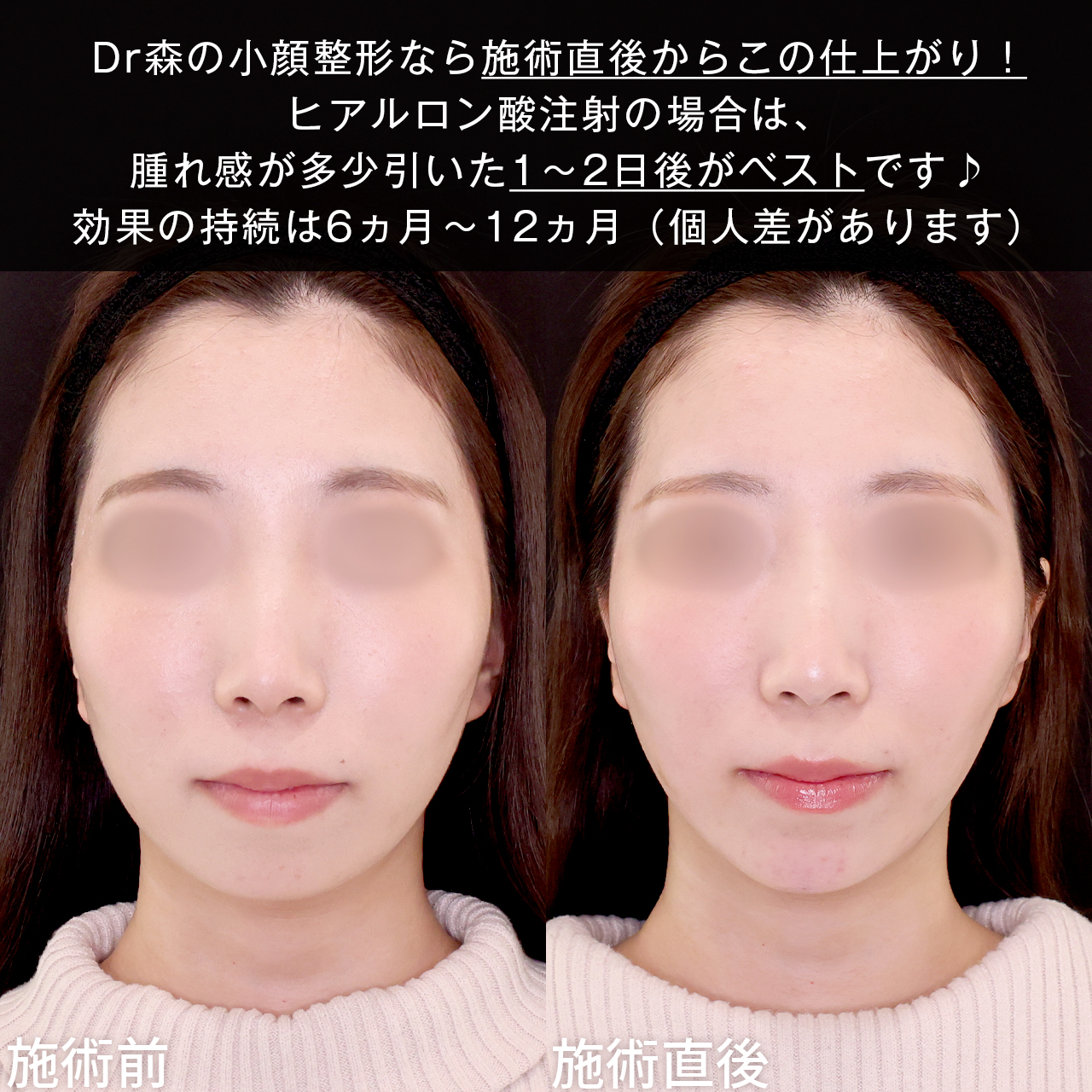 顎のヒアルロン酸注射/TAC式 ツヤ肌コラーゲンリフト®の症例写真 施術前後 