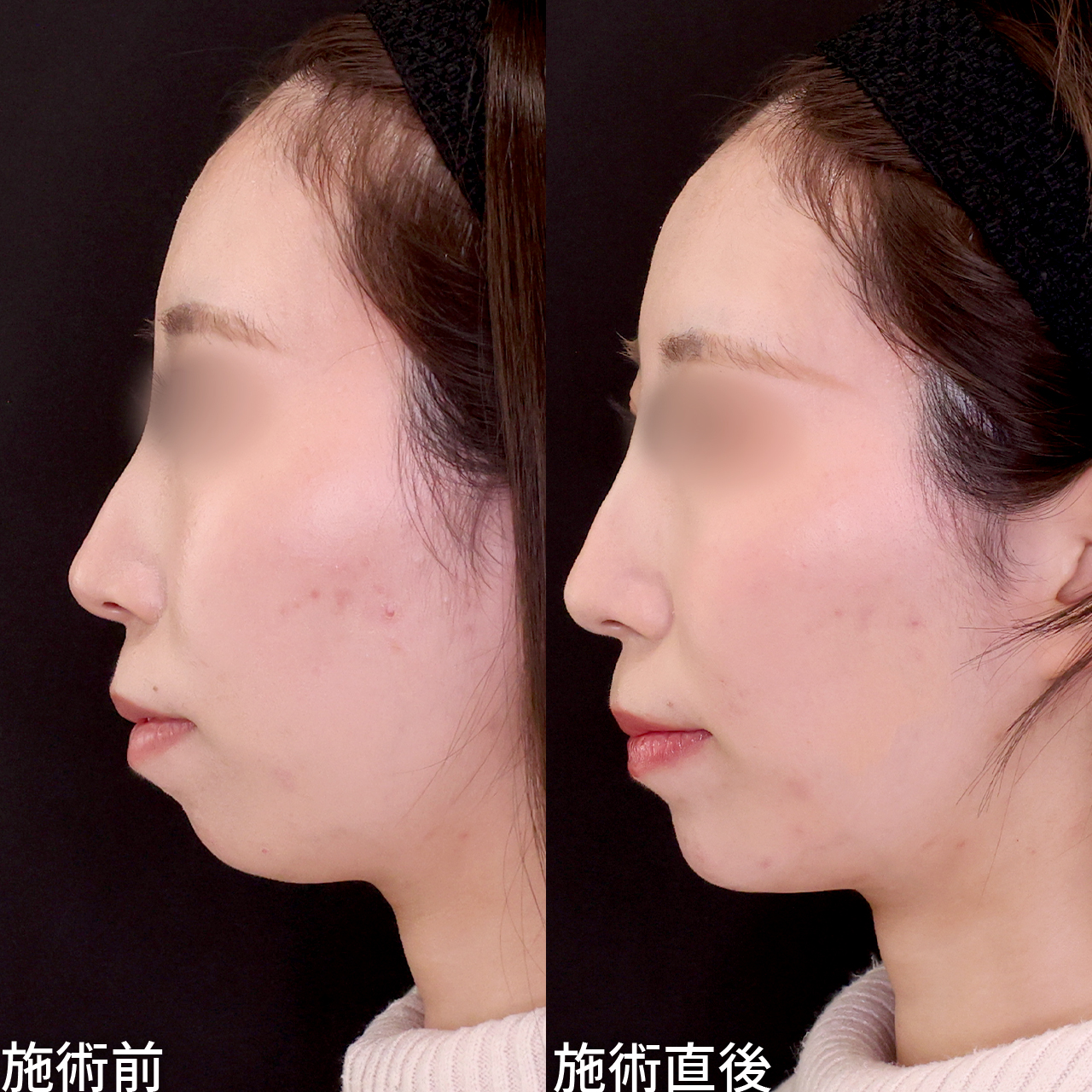 《顎ヒアル注射》自然で洗練されたEライン形成