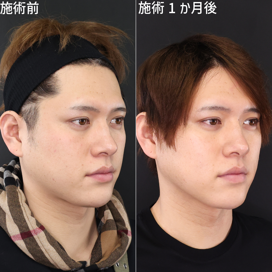 TAC式 ツヤ肌コラーゲンリフト®/ジョールファット除去/顎下の脂肪吸引の症例写真 施術前後 