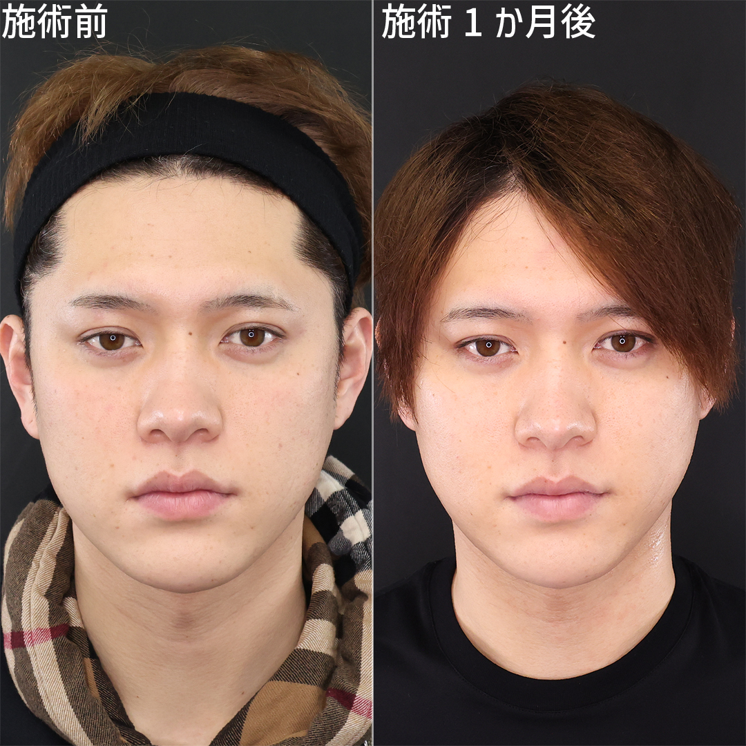 【メンズ小顔整形】綺麗なフェイスライン形成ならDr.森