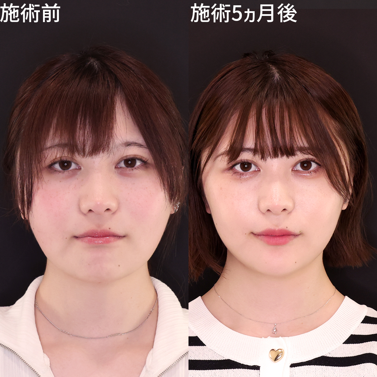 お顔の丸み改善!別人級のフェイスラインに