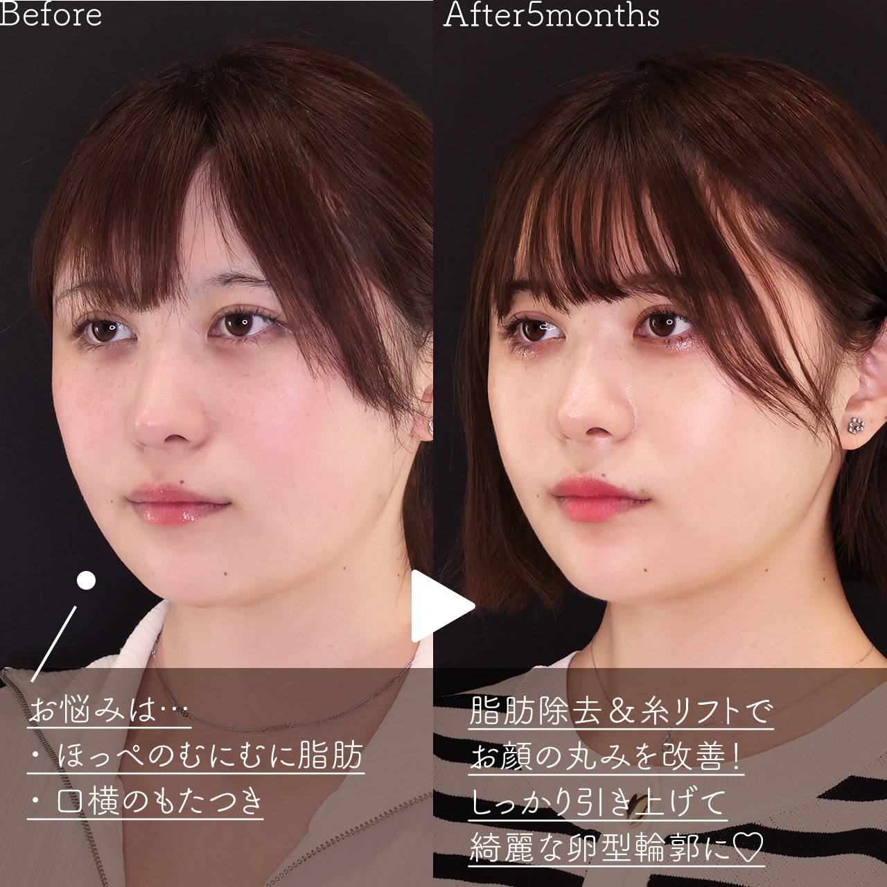 ジョールファット除去/顎下の脂肪吸引/TAC式 ツヤ肌コラーゲンリフト®の症例写真 施術前後 