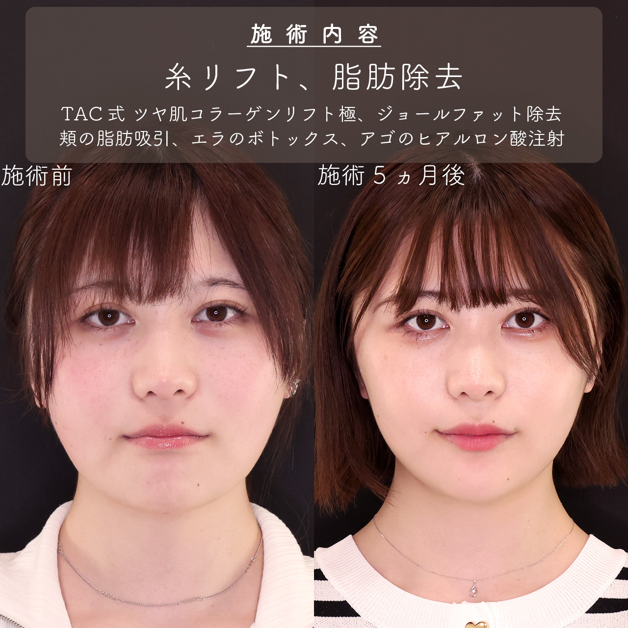 ジョールファット除去/顎下の脂肪吸引/TAC式 ツヤ肌コラーゲンリフト®の症例写真 施術前後 