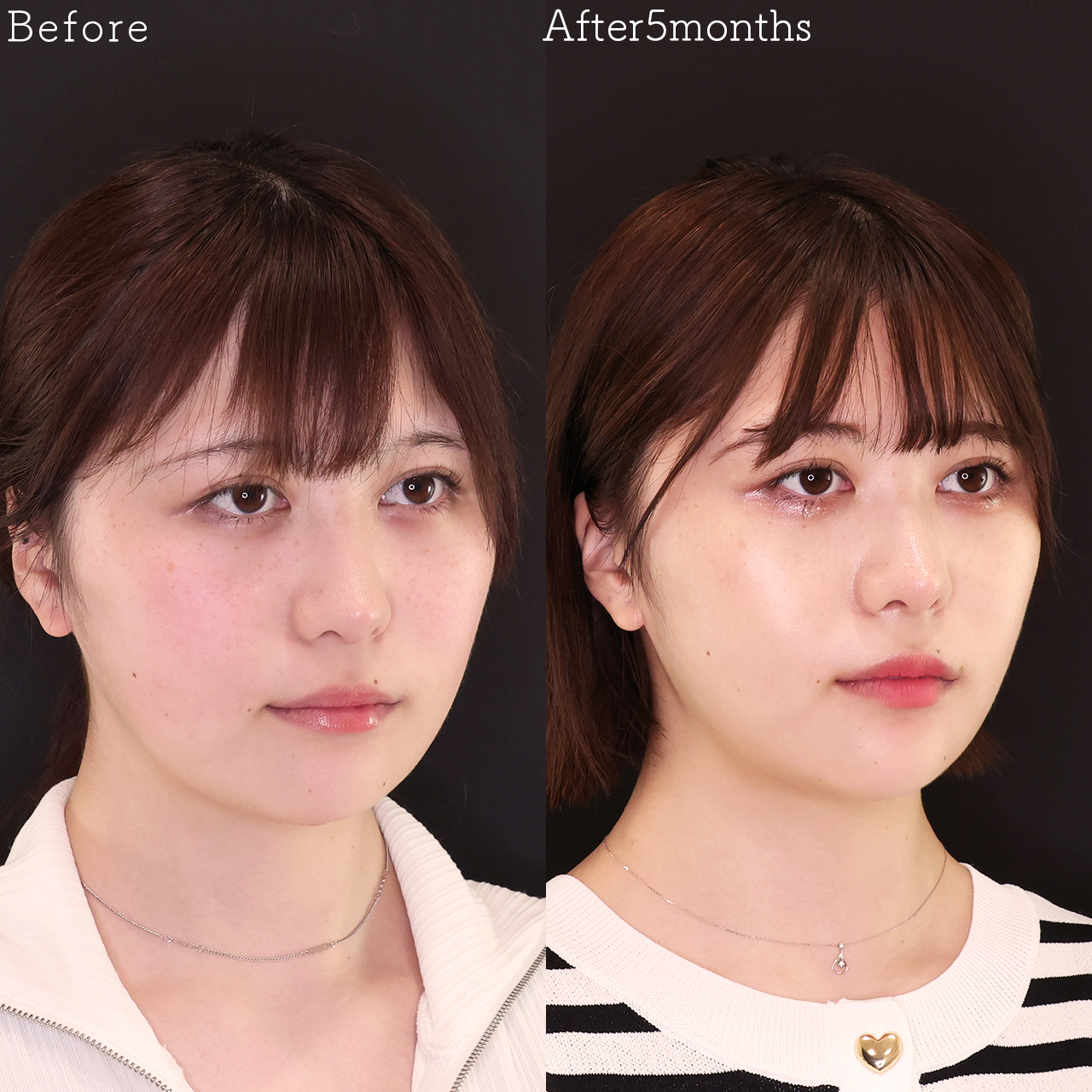 ジョールファット除去/顎下の脂肪吸引/TAC式 ツヤ肌コラーゲンリフト®の症例写真 施術前後 