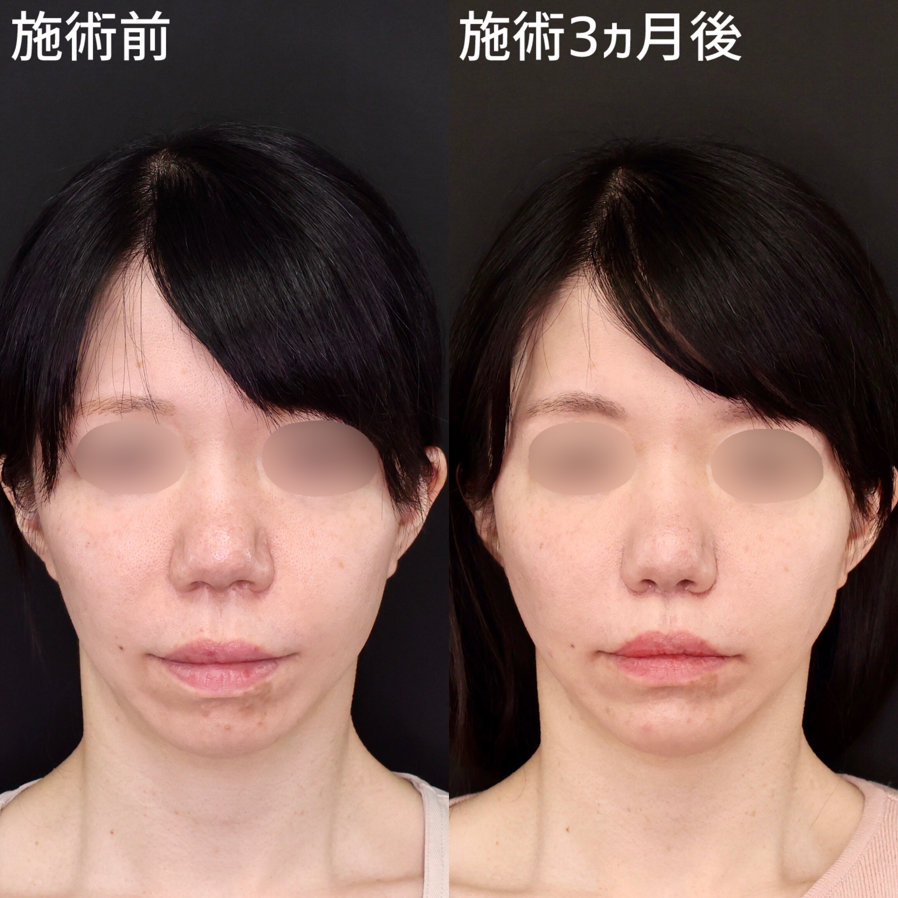 セレクト美容塾・眼瞼 セレクト美容塾・眼瞼 改訂第2版 | 克誠堂出版