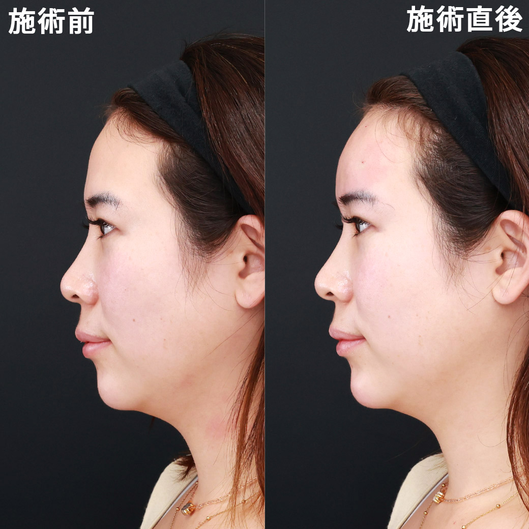 【おでこヒアルロン酸】ゴツゴツとした印象を無くし、丸く女性らしいおでこを形成