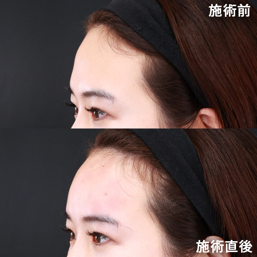 おでこ・こめかみのヒアルロン酸注射/おでこボトックス注射の症例写真 施術前後