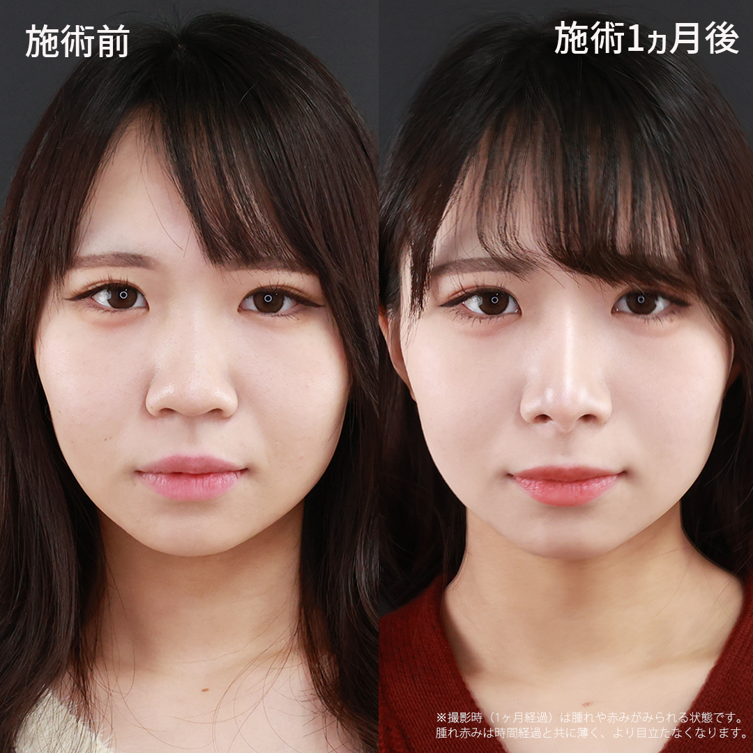 【忘れ鼻整形】ACRのバランスを整えてナチュラルに垢抜ける