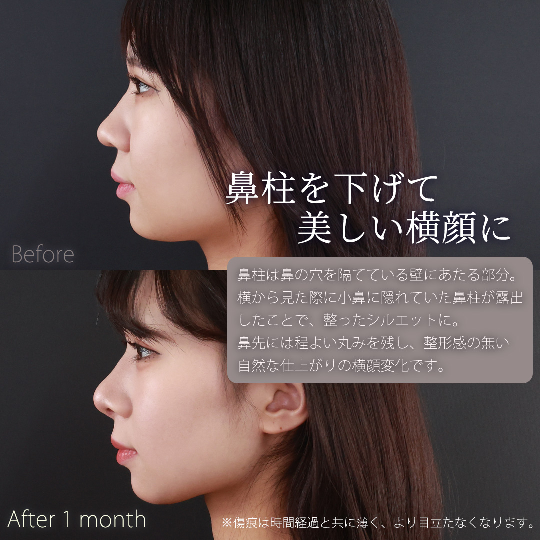 鼻中隔延長術/鼻先軟骨移植/鼻尖形成・鼻尖縮小の症例写真 施術前後 