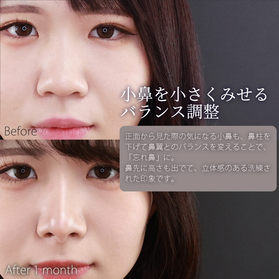 鼻中隔延長術/鼻先軟骨移植/鼻尖形成・鼻尖縮小の症例写真 施術前後 