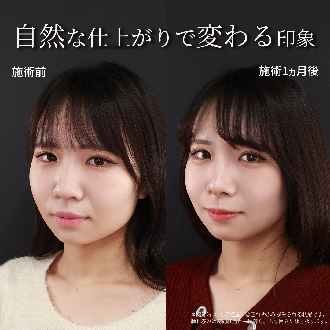 鼻中隔延長術/鼻先軟骨移植/鼻尖形成・鼻尖縮小の症例写真 施術前後 