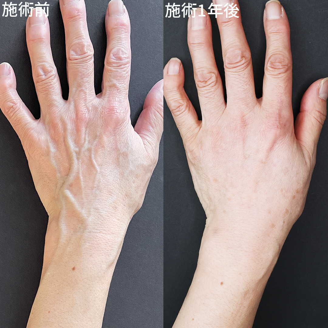 【手の血管治療】血管を無くし、滑らかな美しい手に