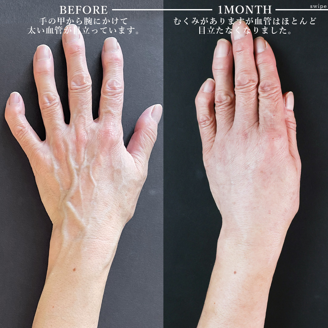 ハンドベイン（手のアンチエイジング・血管治療）の症例写真 施術前後 
