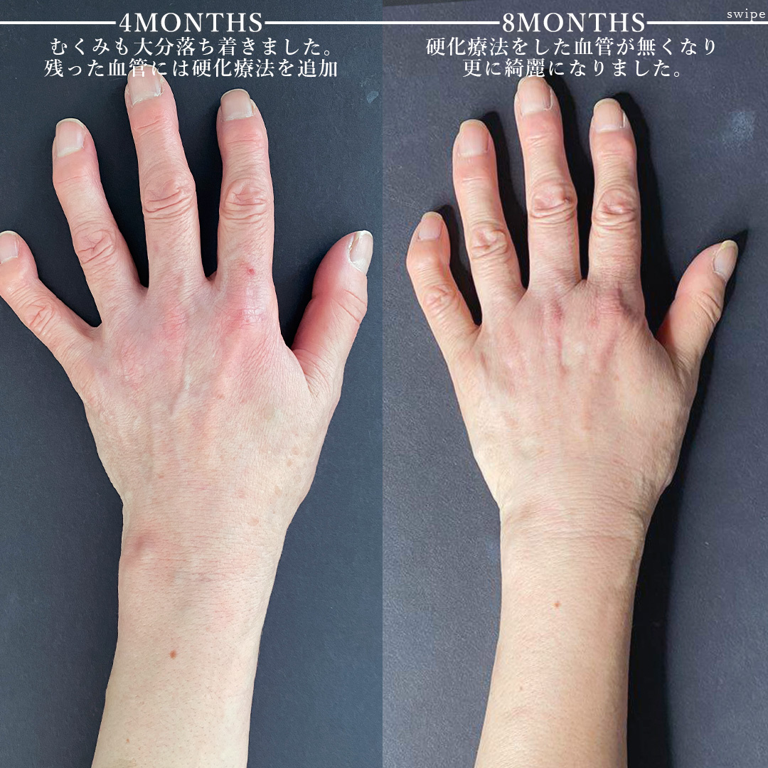 ハンドベイン（手のアンチエイジング・血管治療）の症例写真 施術前後 