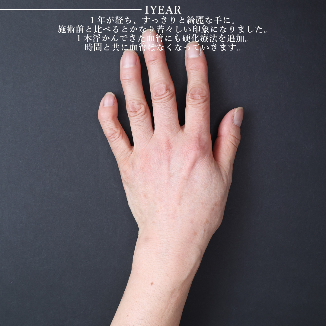 ハンドベイン（手のアンチエイジング・血管治療）の症例写真 施術前後 