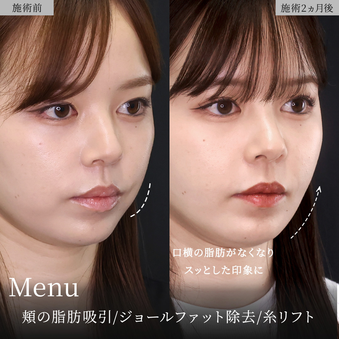 TAC式 ツヤ肌コラーゲンリフト®/ジョールファット除去/Lラインファット除去（エラ下脂肪除去）の症例写真 施術前後 