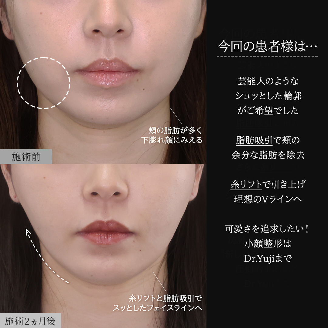 TAC式 ツヤ肌コラーゲンリフト®/ジョールファット除去/Lラインファット除去（エラ下脂肪除去）の症例写真 施術前後 