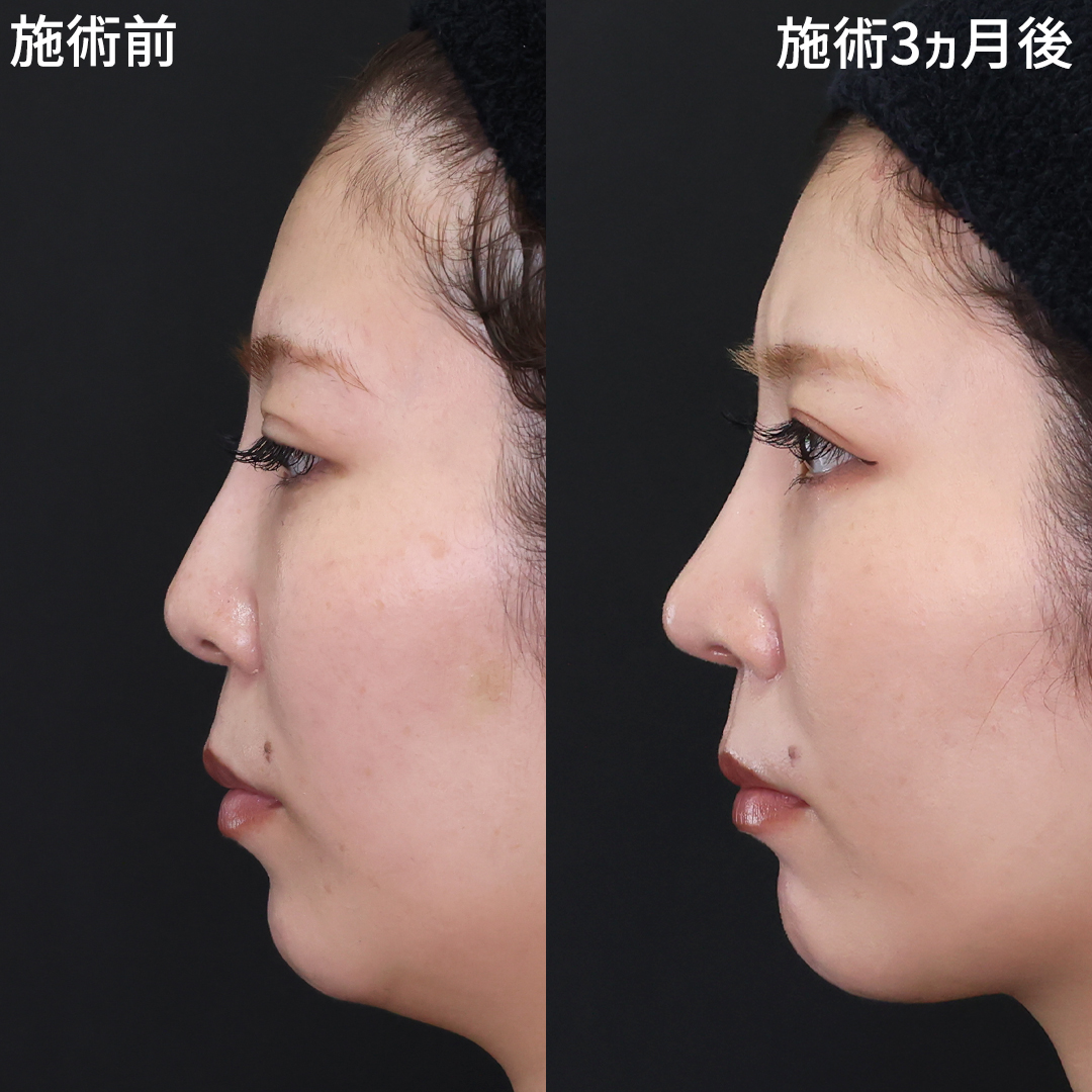 鼻先軟骨移植 仙台の症例写真・画像・ビフォーアフター｜美容