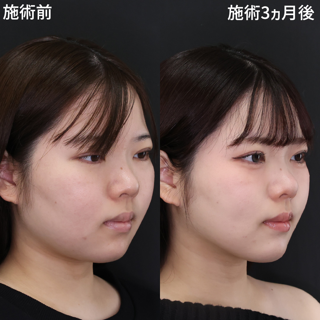 「魅惑のフェイスライン」つくりませんか?