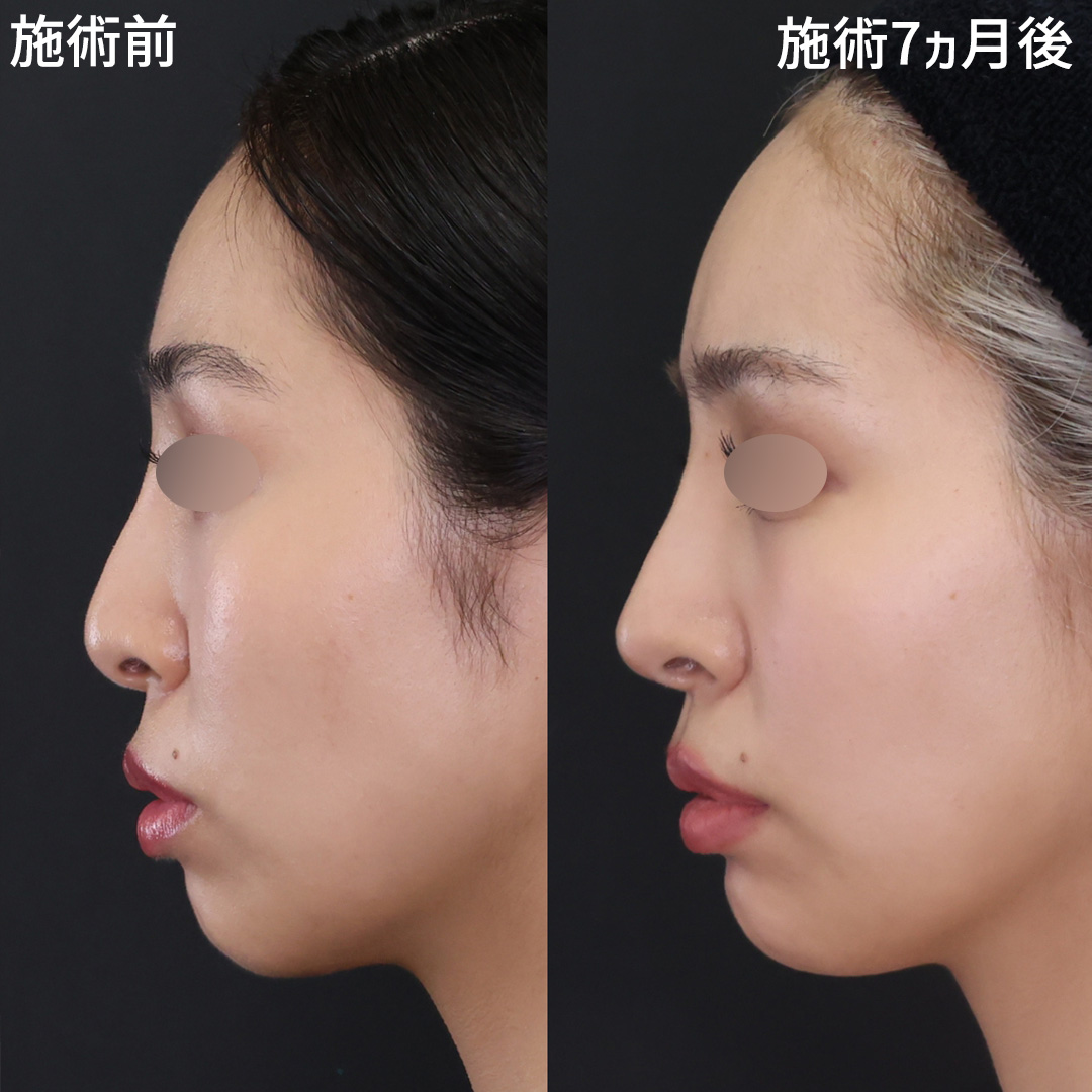 ナチュラルに鼻先を整える～Dr.古川の忘れ鼻形成～
