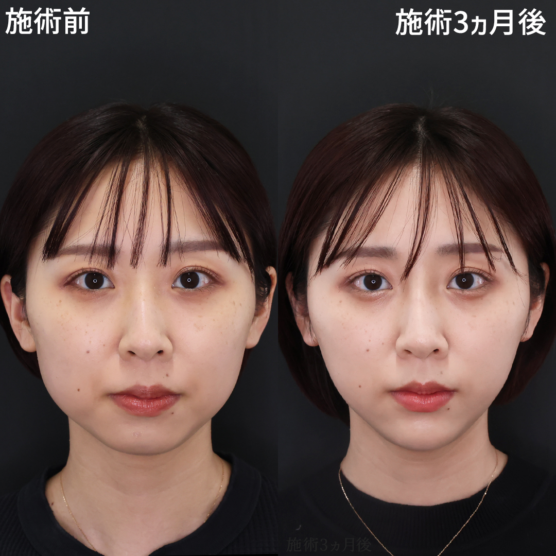 TAC式 ツヤ肌コラーゲンリフト®/顔の脂肪吸引/ジョールファット除去の症例写真 施術前後