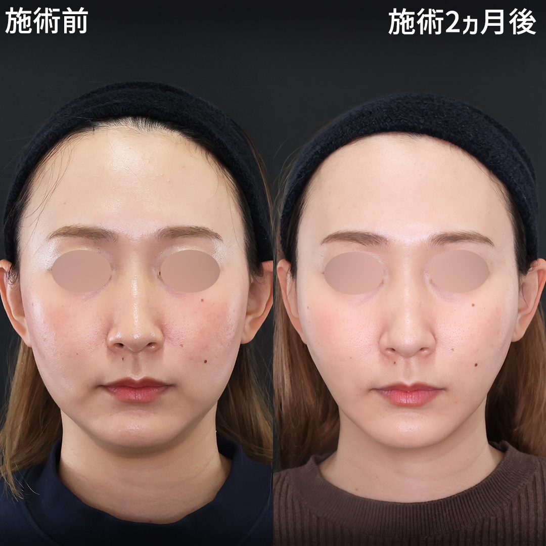 顔の美容外科手術 AB美容整形外科 | AB美容外科の手術で理想の顔にもっと近づく