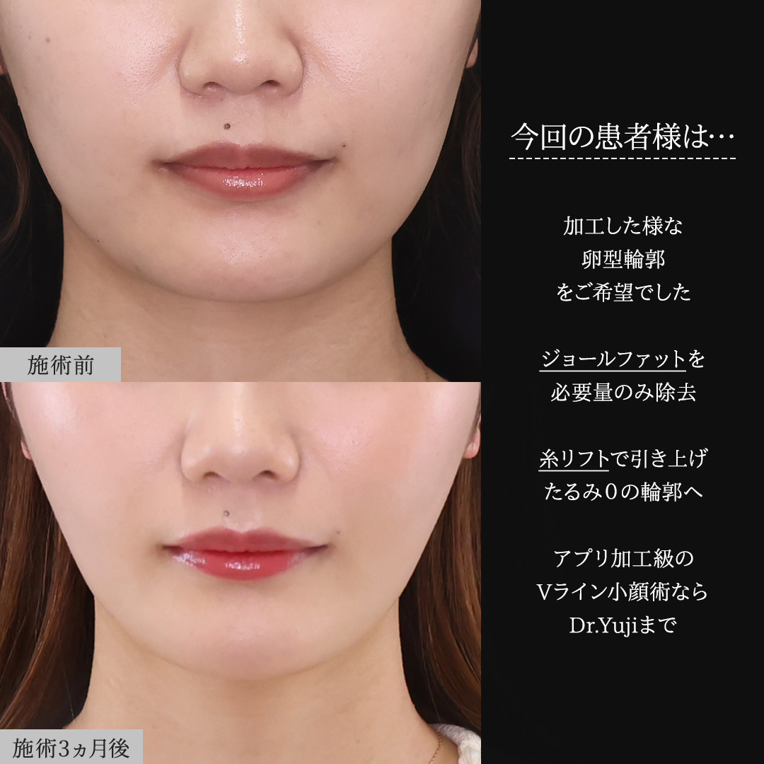 TAC式 ツヤ肌コラーゲンリフト®/ジョールファット除去/Lラインファット除去(エラ下脂肪除去)の症例写真 施術前後