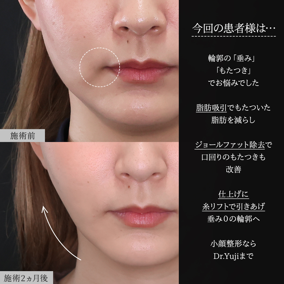 TAC式 ツヤ肌コラーゲンリフト®/顔の脂肪吸引/Lラインファット除去（エラ下脂肪除去）の症例写真 施術前後 