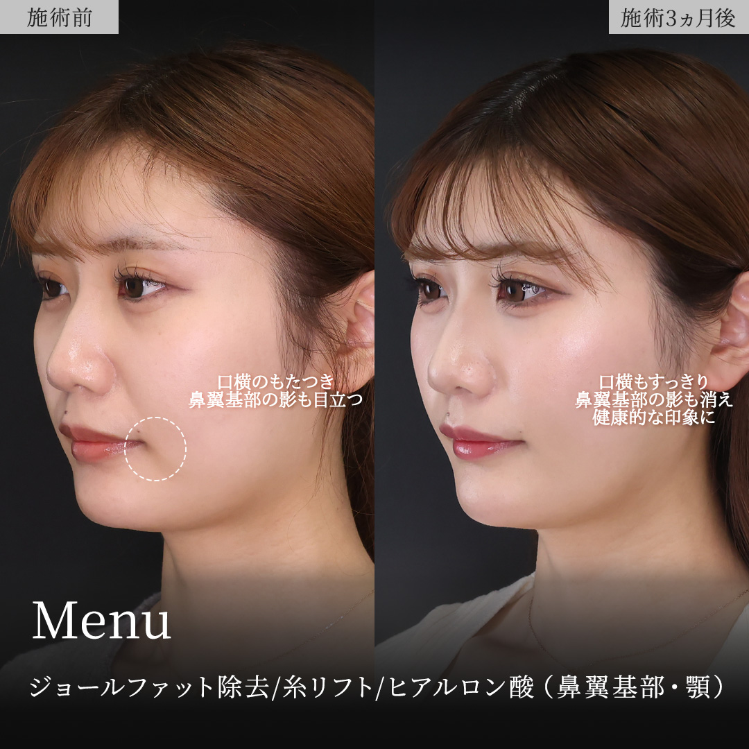 TAC式 ツヤ肌コラーゲンリフト®/ジョールファット除去/Lラインファット除去(エラ下脂肪除去)の症例写真 施術前後