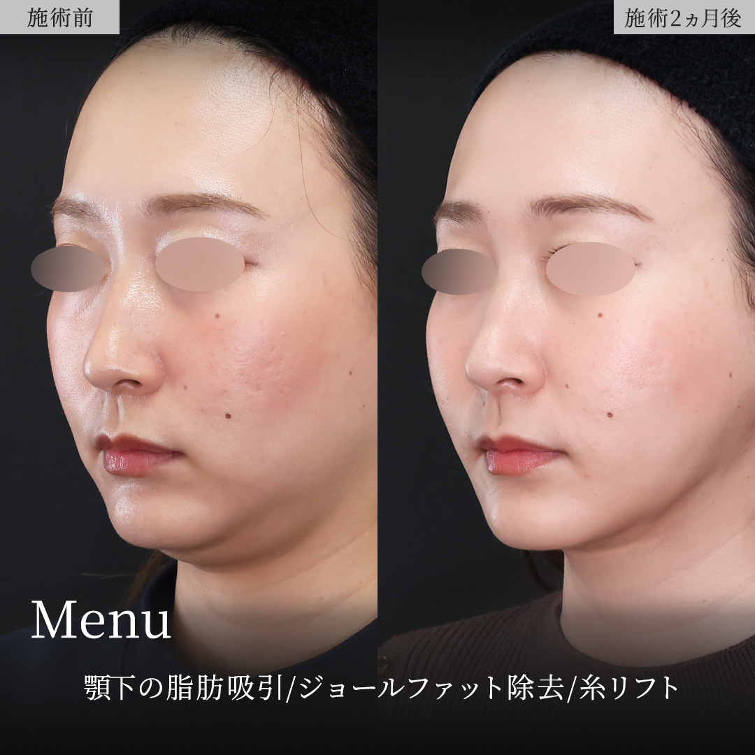 TAC式 ツヤ肌コラーゲンリフト®/顔の脂肪吸引/Lラインファット除去（エラ下脂肪除去）の症例写真 施術前後 