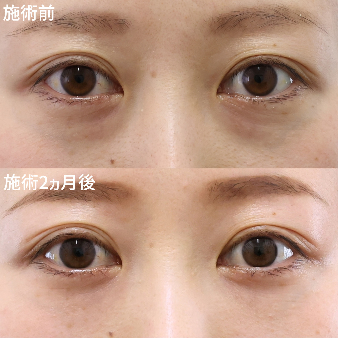下眼瞼脱脂術(目の下のたるみ取り・目の下の脂肪ふくらみ取り)/顔の脂肪注入(コンデンスリッチフェイス)の症例写真 施術前後