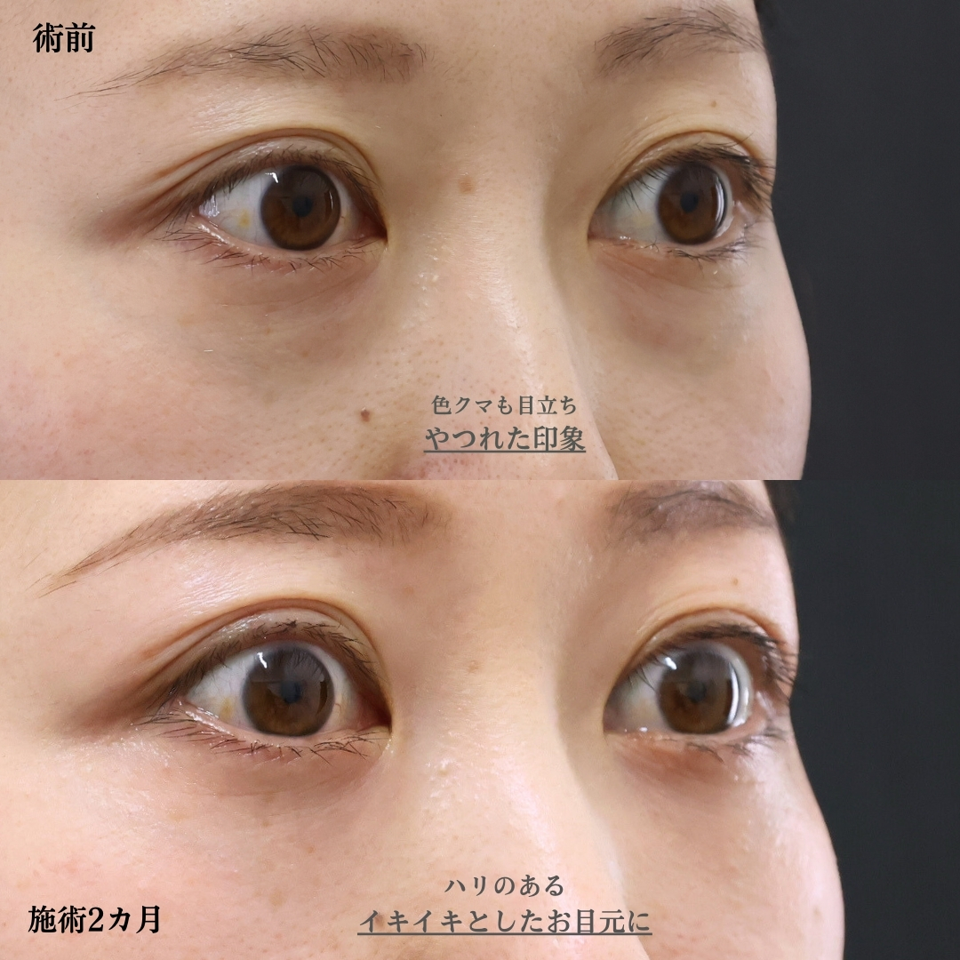 下眼瞼脱脂術(目の下のたるみ取り・目の下の脂肪ふくらみ取り)/顔の脂肪注入(コンデンスリッチフェイス)の症例写真 施術前後
