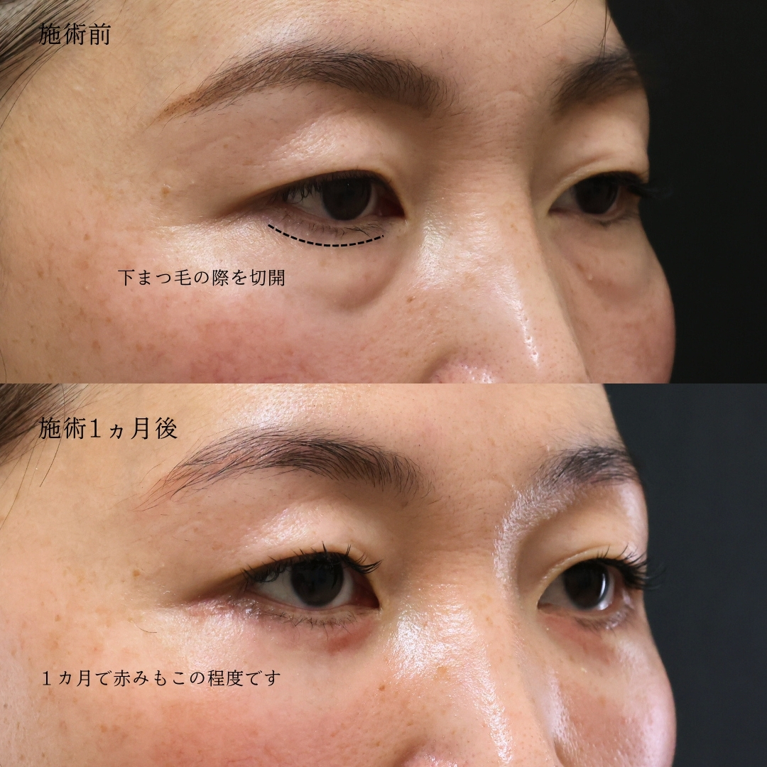 下眼瞼切開術（クマ・たるみとり）の症例写真 施術前後 