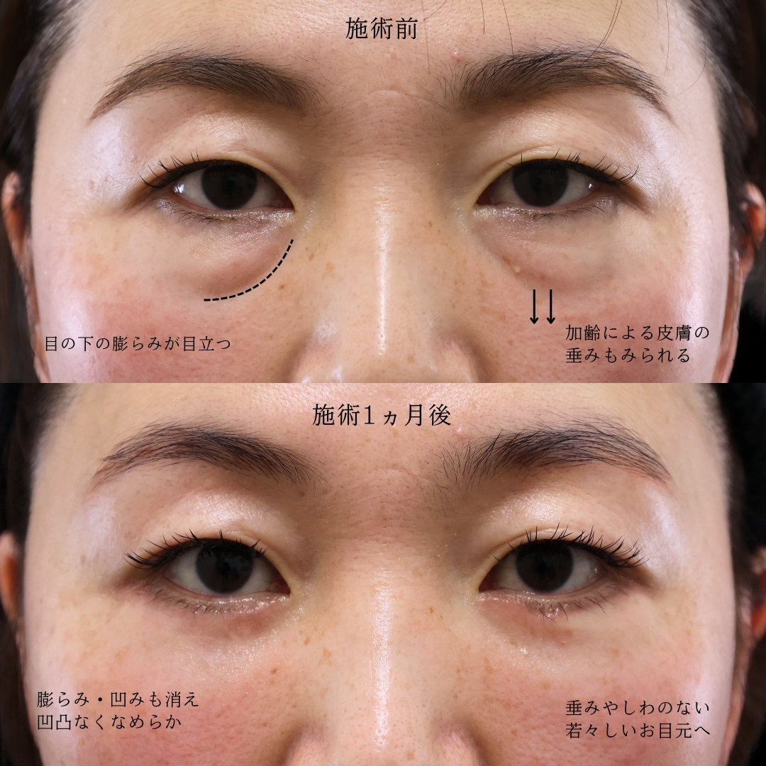 下眼瞼切開術（クマ・たるみとり）の症例写真 施術前後 
