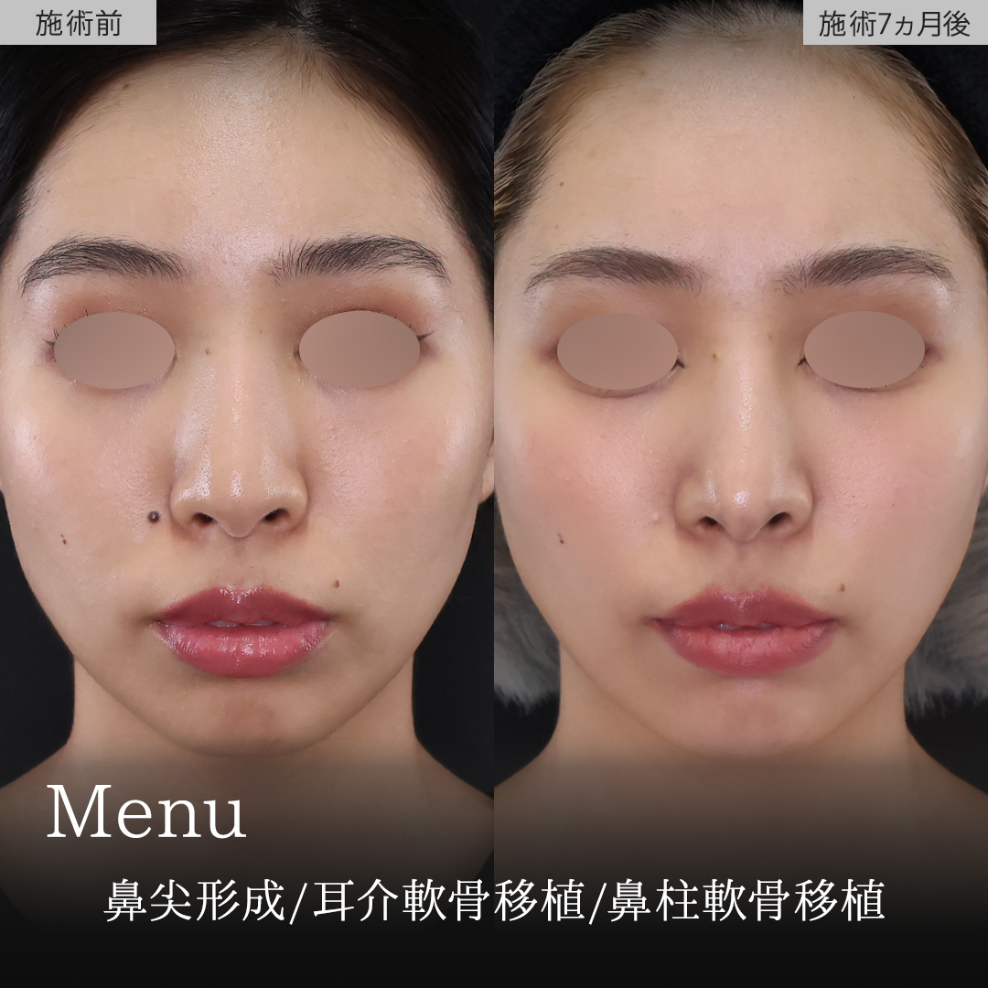 鼻尖形成・鼻尖縮小/鼻先軟骨移植の症例写真 施術前後 