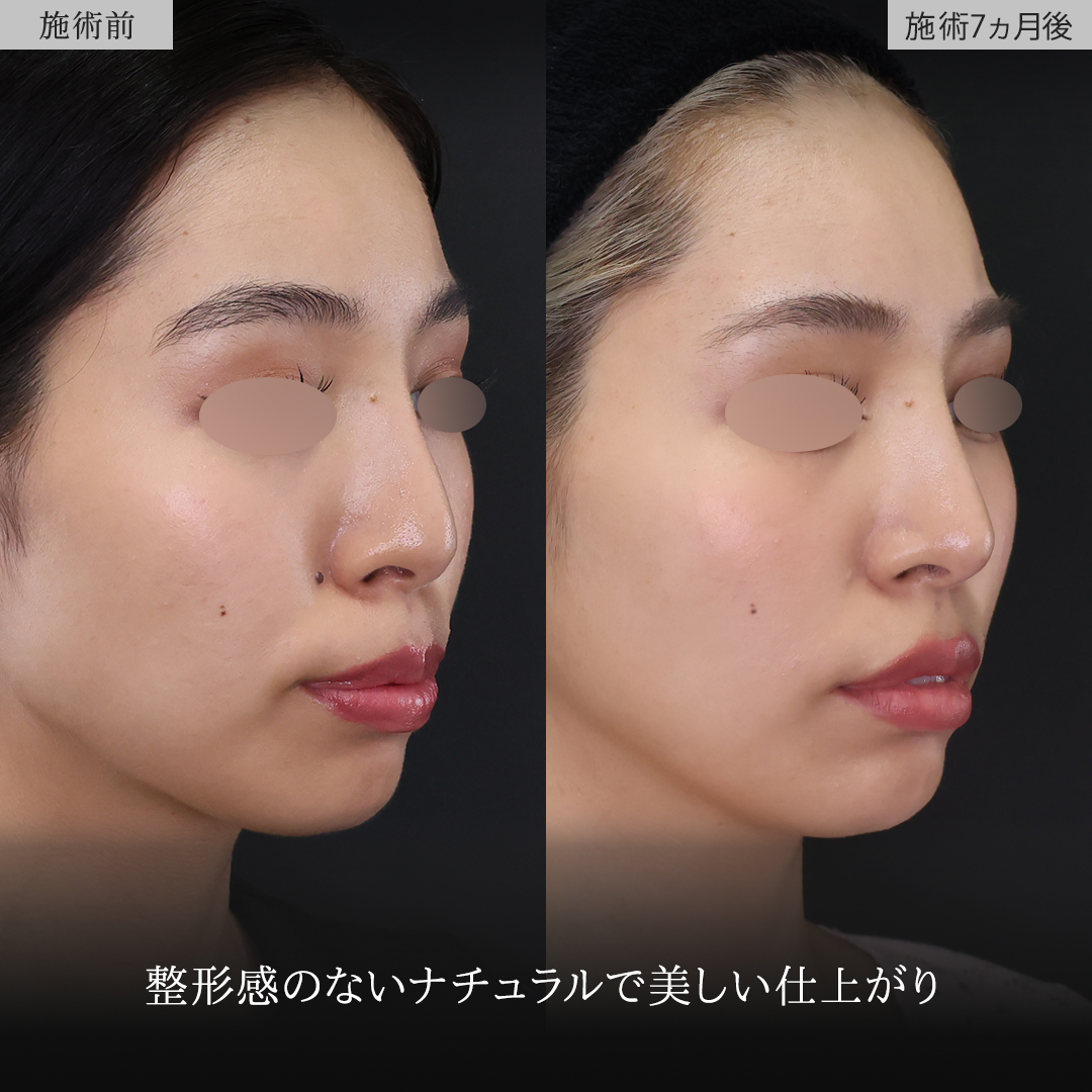 鼻尖形成・鼻尖縮小/鼻先軟骨移植の症例写真 施術前後 