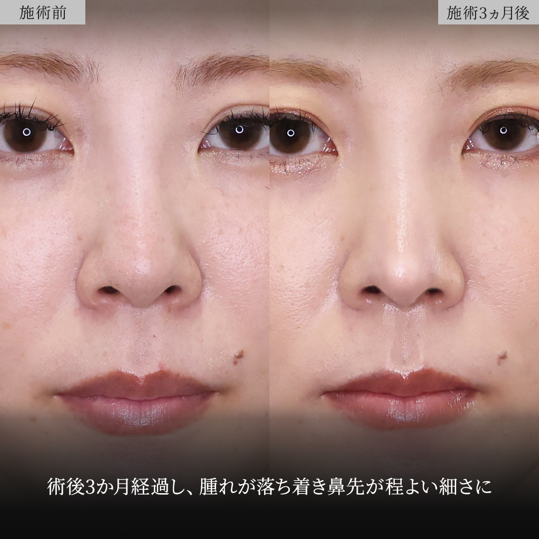鼻中隔延長術/鼻尖形成・鼻尖縮小/鼻先軟骨移植の症例写真 施術前後