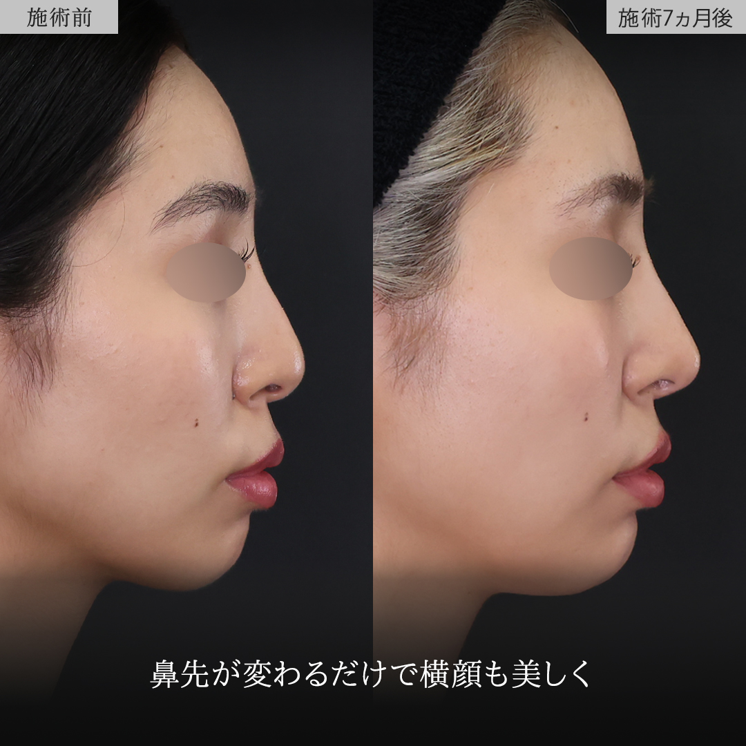 鼻尖形成・鼻尖縮小/鼻先軟骨移植の症例写真 施術前後 