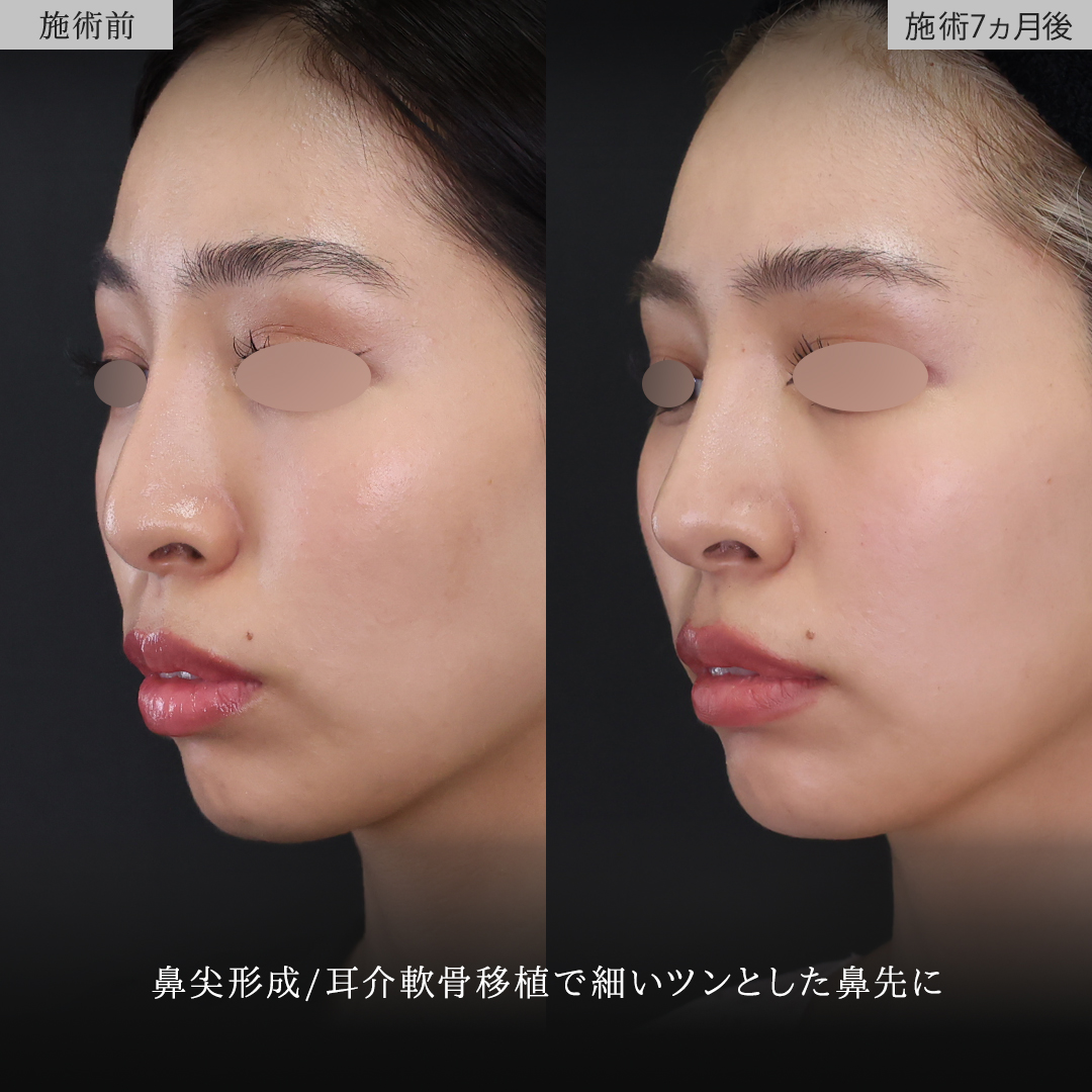 鼻尖形成・鼻尖縮小/鼻先軟骨移植の症例写真 施術前後 