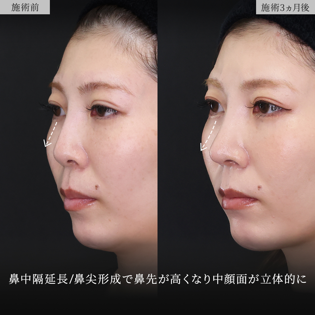 鼻中隔延長術/鼻尖形成・鼻尖縮小/鼻先軟骨移植の症例写真 施術前後