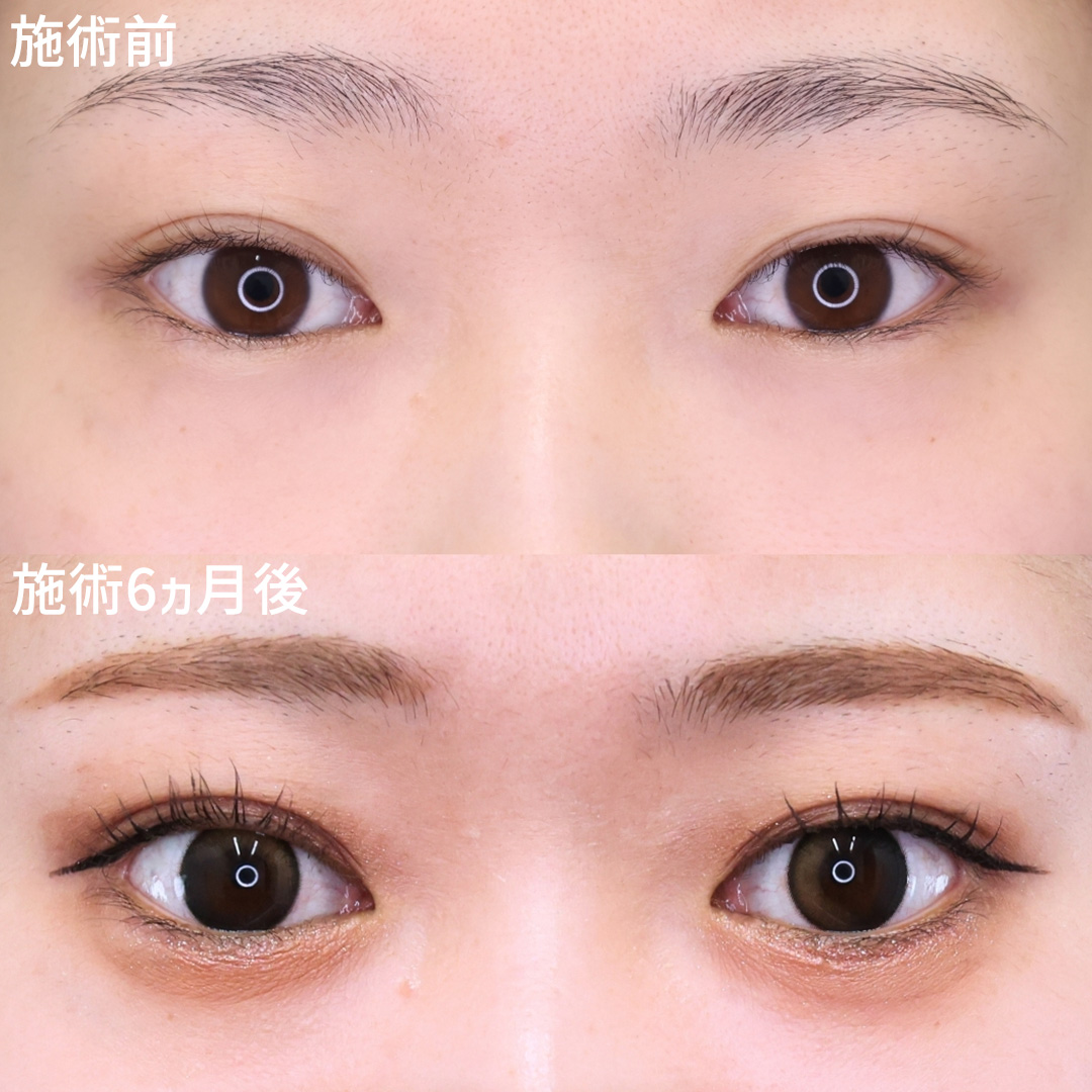 韓流猫目を手にいれる！Dr.古川のタレ目形成/目尻切開