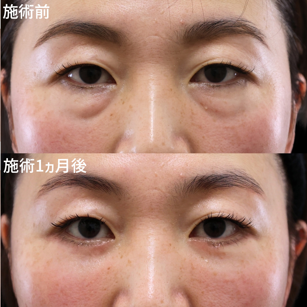 「膨らみ・たるみ・凹み」一気に改善！表ハムラ