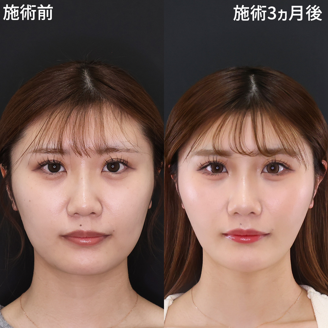 もたつき0の輪郭へ、小顔→「超」小顔美人に