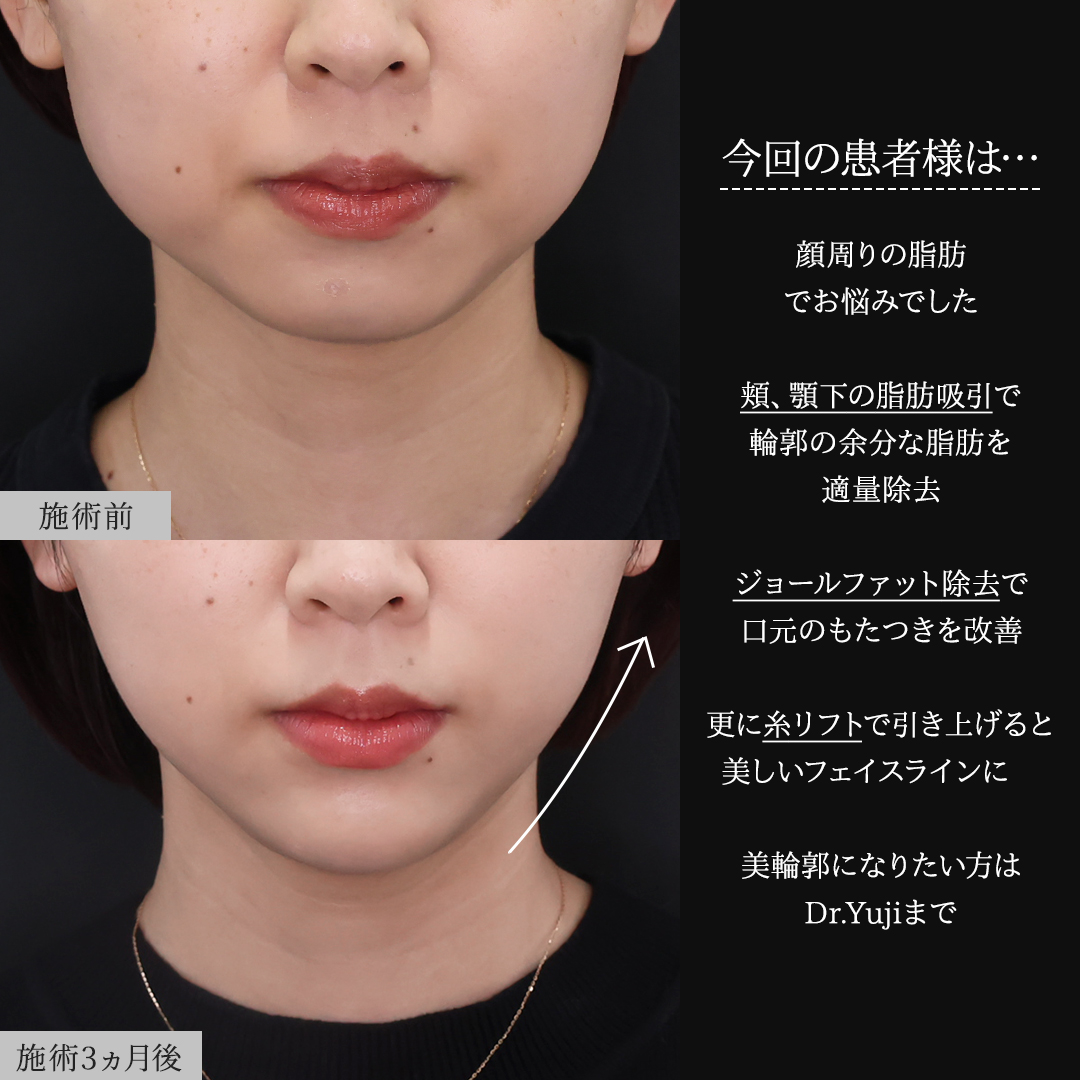 TAC式 ツヤ肌コラーゲンリフト®/顔の脂肪吸引/ジョールファット除去の症例写真 施術前後 