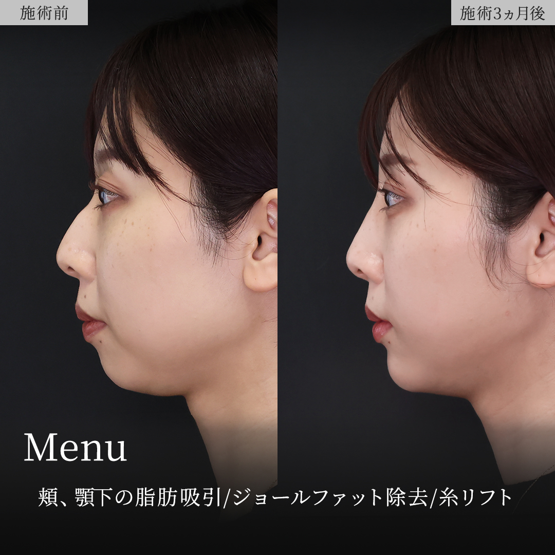 TAC式 ツヤ肌コラーゲンリフト®/顔の脂肪吸引/ジョールファット除去の症例写真 施術前後 